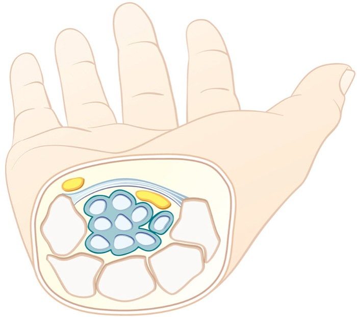 Syndrome de la loge de Guyon